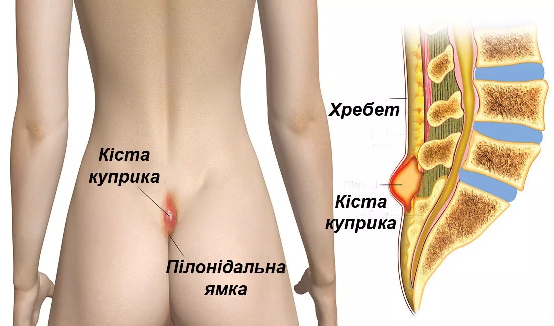 Анатомія кісти куприка