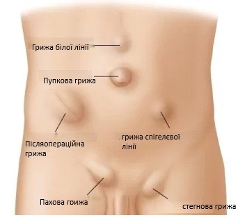 Причини утворення гриж
