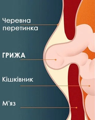 Діагностика грижі