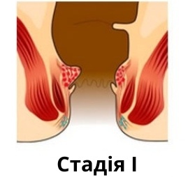 Перша стадія геморою