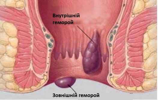 Геморой