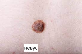 Невус (родимка)