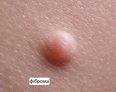 Фіброма