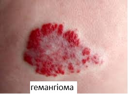 Гемангіома