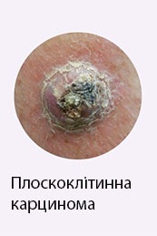 Плоскоклітинна карценома