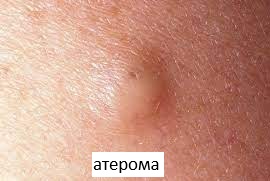 Атерома